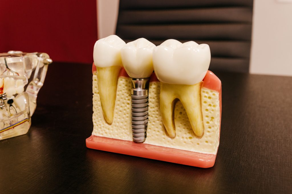 Dental implant screws and models arranged on a clinic table